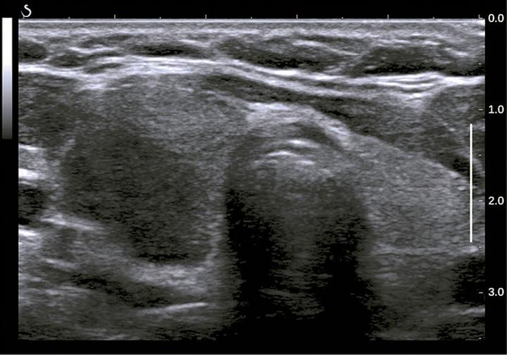 Wczesne wykrywanie i diagnostyka tarczycy