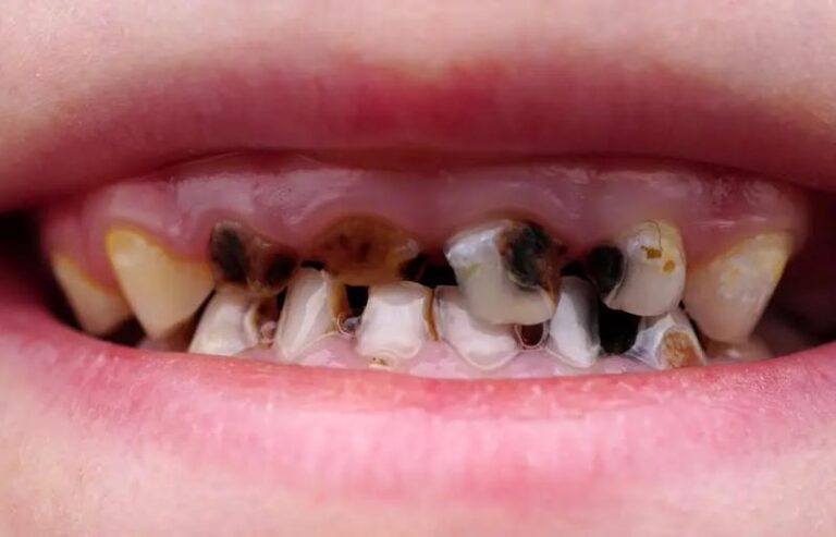 Skuteczne metody, jak zapobiec próchnicy u dzieci w prosty sposób