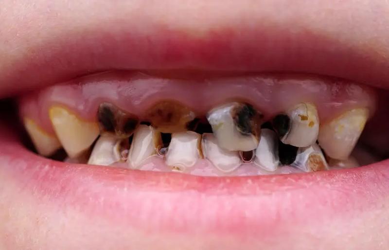 Skuteczne metody, jak zapobiec próchnicy u dzieci w prosty sposób